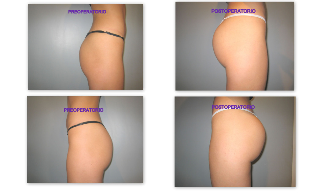 Antes – despues