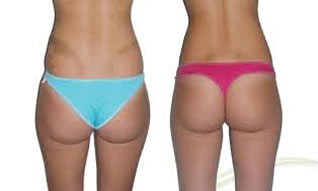 lipo