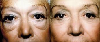 Antes – Despues Antes – Despues