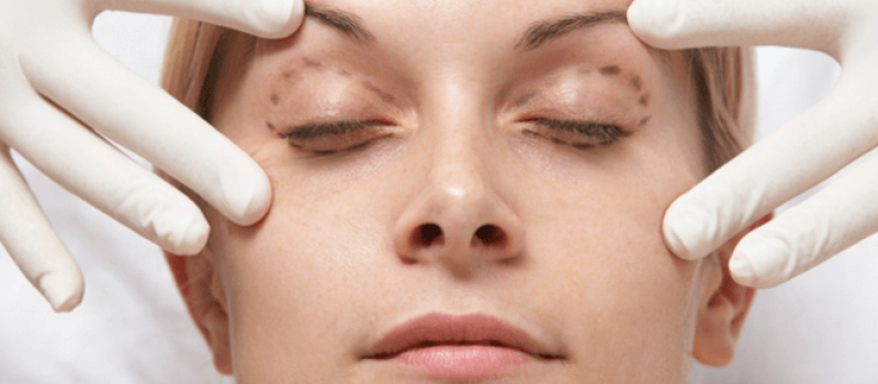 blefaroplastia parpados