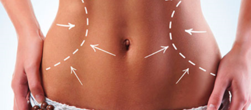 abdominosplastia